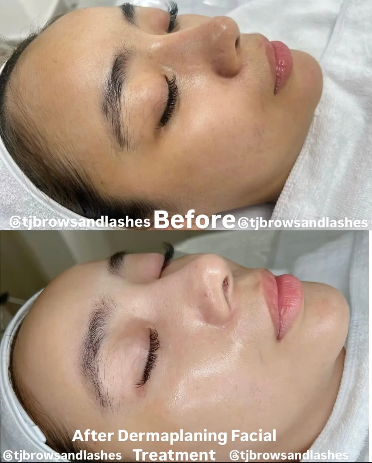Skin improvement after facial treatment